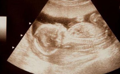 试管婴儿是在试管里长大的吗？试管婴儿诞生全过程！